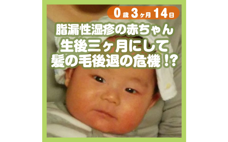 脂漏性湿疹 ０歳児にして髪の毛後退の危機 コレ芝 幼児日本語教育